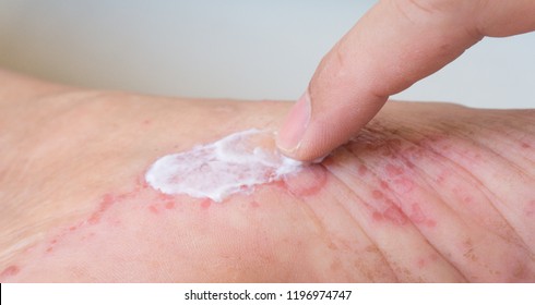 Applying Topical Steroid Ointment To A Contact Dermatitis Skin Rash.Atopic Dermatitis Or Atopic Eczema, Is A Type Of Inflammation Of The Skin At Foot.