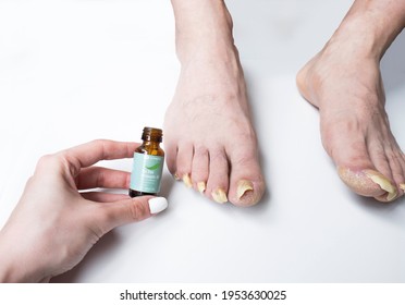 April 2021,Swansea, UK. Woman Is Applying Tea Tree Oil, Nail Fungus Treatment To Man's Infected Long Nails