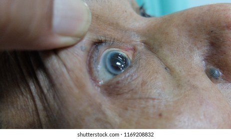 Archus Sinelis In Elderly With Hypercholesterolemia.