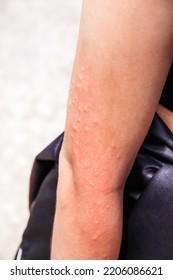 Arm Asian Woman Have Red Rash On Skin From Insect Bites Allergy , Itchy	