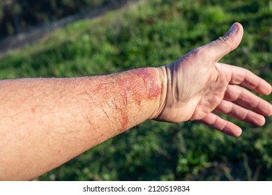 A arm badly affected by phytophotodermatitis. copy space