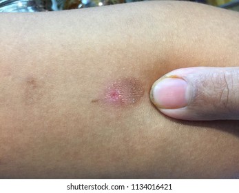 Arm Scald,Wounds Caused By Scalding Hot Water,Wound Inflammation