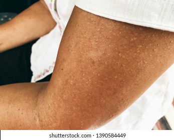 Arm skin is sweating because hot temperature like a sauna or hard exercise.