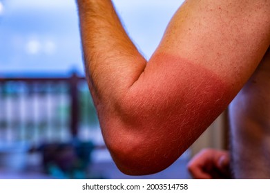 Arm With Visible Red Sunburn Caused By Wearing A Shirt