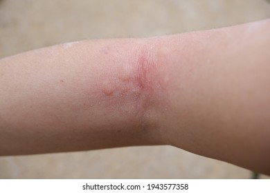 The Arm Wound Is Swollen And Red Due To Fire Ant Bite