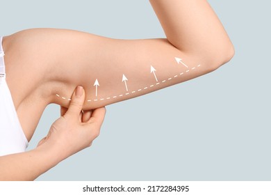 Arm of young woman after slimming on light background. Plastic surgery concept - Shutterstock ID 2172284395