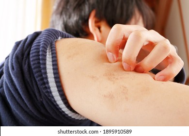 Arms Of A Japanese Man. His Arms Are Brown Due To Hyperpigmentation Caused By Scratching From Atopic Dermatitis.