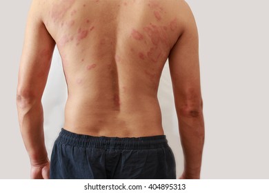 Around Back View Of Man With Dermatitis Problem Of Rash ,Allergy Rash