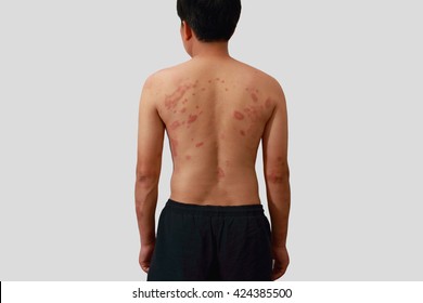 Around Back View Of Man With Dermatitis Problem Of Rash ,Allergy Rash