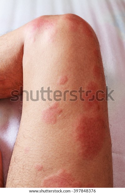 Around Legs Man Dermatitis Problem Rash Stock Photo (Edit Now) 397848376