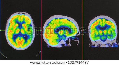 an array of positron emission tomography or PET images showing many phase of brain perfusion function and activity