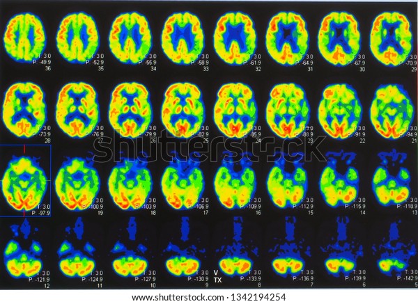 an array\
of positron emission tomography or PET images showing many phases\
of brain perfusion function and\
activity