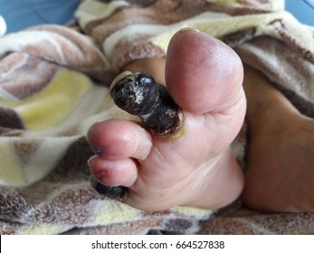 Arterial Disease Showing Gangrene And Ulcerations Of The Toes