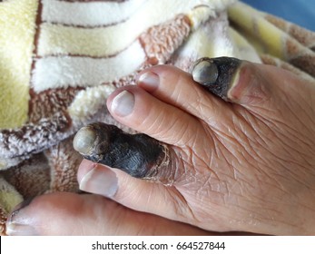 Arterial Disease Showing Gangrene And Ulcerations Of The Toes