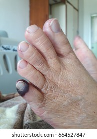 Arterial Disease Showing Gangrene And Ulcerations Of The Toes