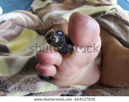 Arterial Disease showing gangrene and ulcerations of the toes