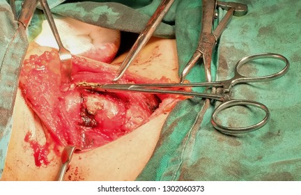 Artery Forcep being placed to clamp the end of Isthmus before the Right lobe and Isthmus removed.