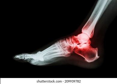 Arthritis at ankle joint (Gout , Rheumatoid arthritis) 