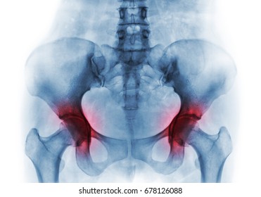 Arthritis Both Hip . Film X-ray Of Human Pelvis .