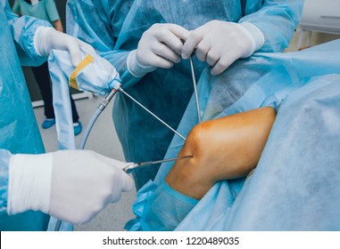Arthroscope surgery. Orthopedic surgeons in teamwork in the operating room with modern arthroscopic tools. Knee surgery. Hospital background