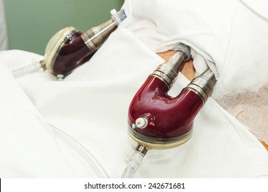 Artificial Heart In Humans