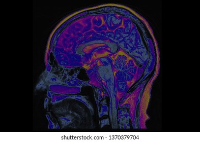 Artificial Intelligence In Medical Imaging/ Smart Healthcare Hospital Technology Concept/ Brain MRI Scan