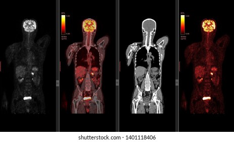 Artificial Intelligence In Medical Imaging/ Smart Healthcare Hospital Technology Concept/ Positron Emission Tomography Or PET CT Scan 