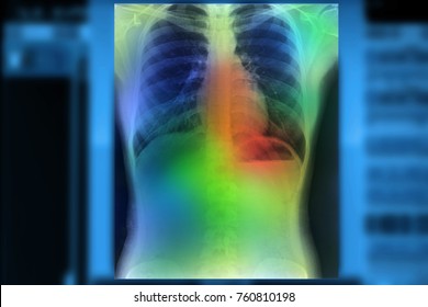 Artificial Intelligence In Smart Healthcare Hospital Technology Concept. AI Biomedical Algorithm And Machine Learning Detect Pneumonia And Cancer Cell In X-Rays Process.