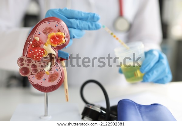Artificial model of kidney\
and ureter of human standing on table of urologist doctor with\
urine test closeup