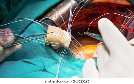 Artifitial Heart Valve Implantation