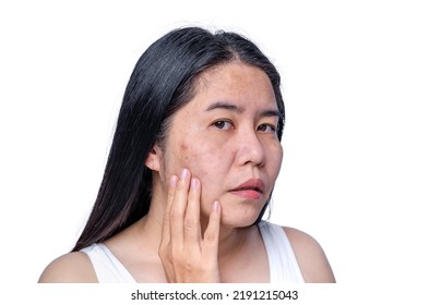 Asian adult woman face has freckles, large pores, blackhead pimple and scars problem from not take care for a long time. Skin problem face isolated white background. Treatment and Skincare concept - Shutterstock ID 2191215043