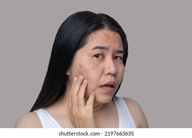 Asian adult woman's face has freckles, large pores, blackhead pimples and scars problem from not take care for a long time. Skin problem face isolated white background. Treatment and Skincare concept - Shutterstock ID 2197663635