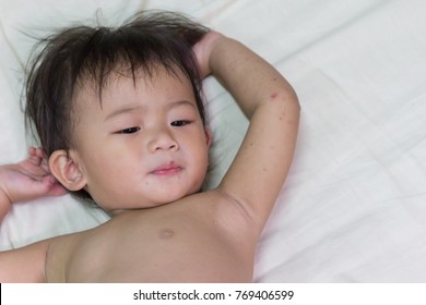 Asian Baby Infected, Hand Foot And Mouth Disease.