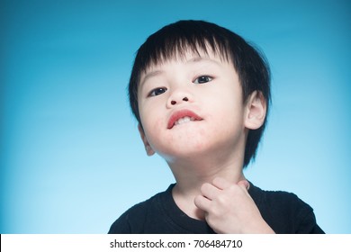 Asian Boy Got Dairy Or Milk Allergy, Got Red Skin Rash Around His Month, Keep Scratching, Blue Background