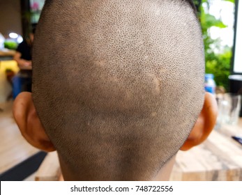 Asian Boy Shave Head With Scar