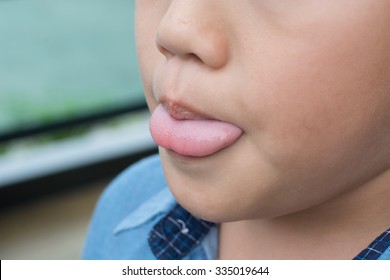 Asian Boy With Tongue Tie, Post Operation.