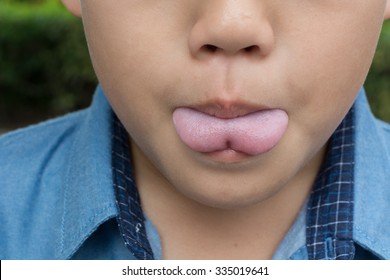 Asian Boy With Tongue Tie, Pre Operation.