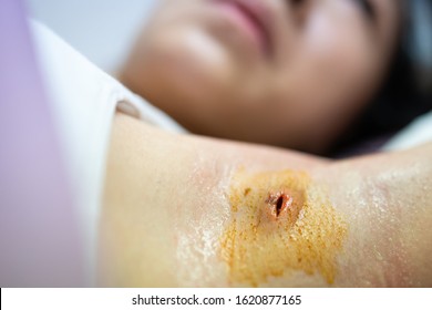 Asian Child Girl Showing Surgical Wounds,abscess Surgery,incision And Drainage And Clean Affected Area With An Antiseptic Wash And Apply Tincture To Treat Minor Wounds,reduce Risk Of Wound Infection