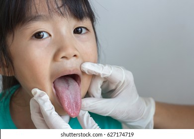 Asian Child Show Her Tongue To The Doctor ,she Has Geographic Tongue