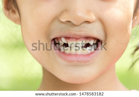 asian child smile and show her crowding tooth