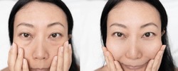 Asian Close Up Woman Happy Face Before After Cosmetic Procedures. Skin Care Wrinkled Face, Dark Circles Under Eyes. Before-after Anti-aging Face Lift Treatment. Facial Skincare, Beauty Contouring