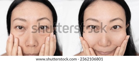 Asian close up woman happy face before after cosmetic procedures. Skin care wrinkled face, dark circles under eyes. Before-after anti-aging face lift treatment. Facial skincare, beauty contouring