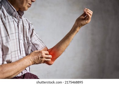 Asian Elder Man Scratching His Arm. Concept Of Itchy Skin Diseases Such As Scabies, Fungal Infection, Eczema, Psoriasis, Allergy, Etc.