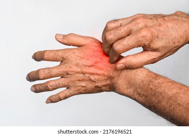 Asian Elder Man Scratching His Hand. Concept Of Itchy Skin Diseases Such As Scabies, Fungal Infection, Eczema, Psoriasis, Allergy, Etc.