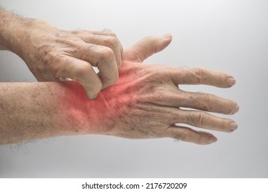 Asian Elder Man Scratching His Hand. Concept Of Itchy Skin Diseases Such As Scabies, Fungal Infection, Eczema, Psoriasis, Allergy, Etc.