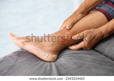 Asian elderly woman holding hands on her leg with gangrene due to diabetes, health care concept and occupational health