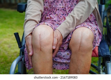 Asian Elderly Woman Patient With Scar Knee Replacement Surgery In Hospital.