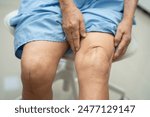 Asian elderly woman patient show her scars surgical total knee joint replacement Suture wound surgery arthroplasty.