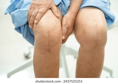 Asian elderly woman patient show her scars surgical total knee joint replacement Suture wound surgery arthroplasty in hospital.