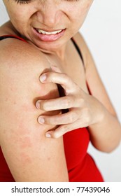 Asian Ethnic Adult Woman With Allergy Skin Scratch Itchy Arm